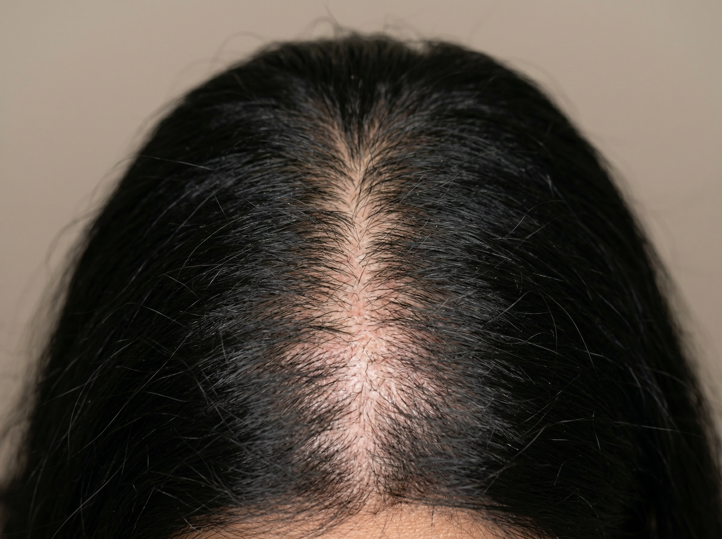 Scalp with visible thinning and wide parting - Day 1
